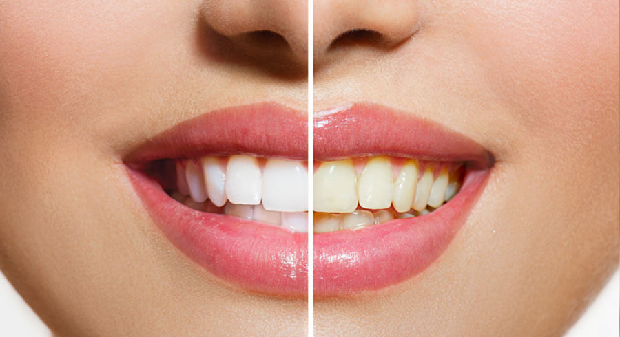 Strahlendes Weiß dank Bleaching der Zähne in der Zahnarztpraxis Essen-Kupferdreh